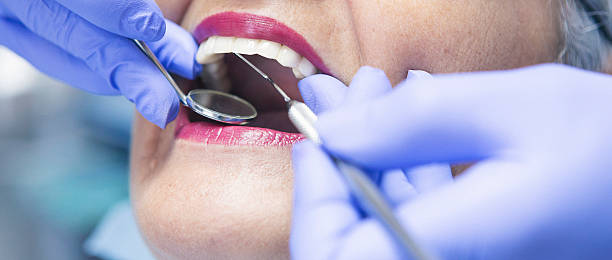 Best Knocked-Out Tooth (Avulsed Tooth) Treatment in Broadview Heights, OH